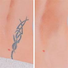 Tattoo Removal