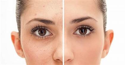 Warts Treatment